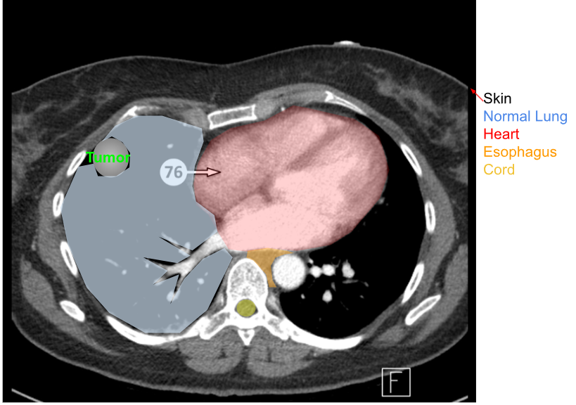 <ol><li><p>normal lung tissue</p></li><li><p>esophagus </p></li><li><p>heart </p></li><li><p>spinal cord </p></li><li><p>skin </p></li></ol><p></p>