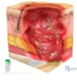 <p>Loss of skin and tissue; exposed bones, cartilage or tendon.</p>