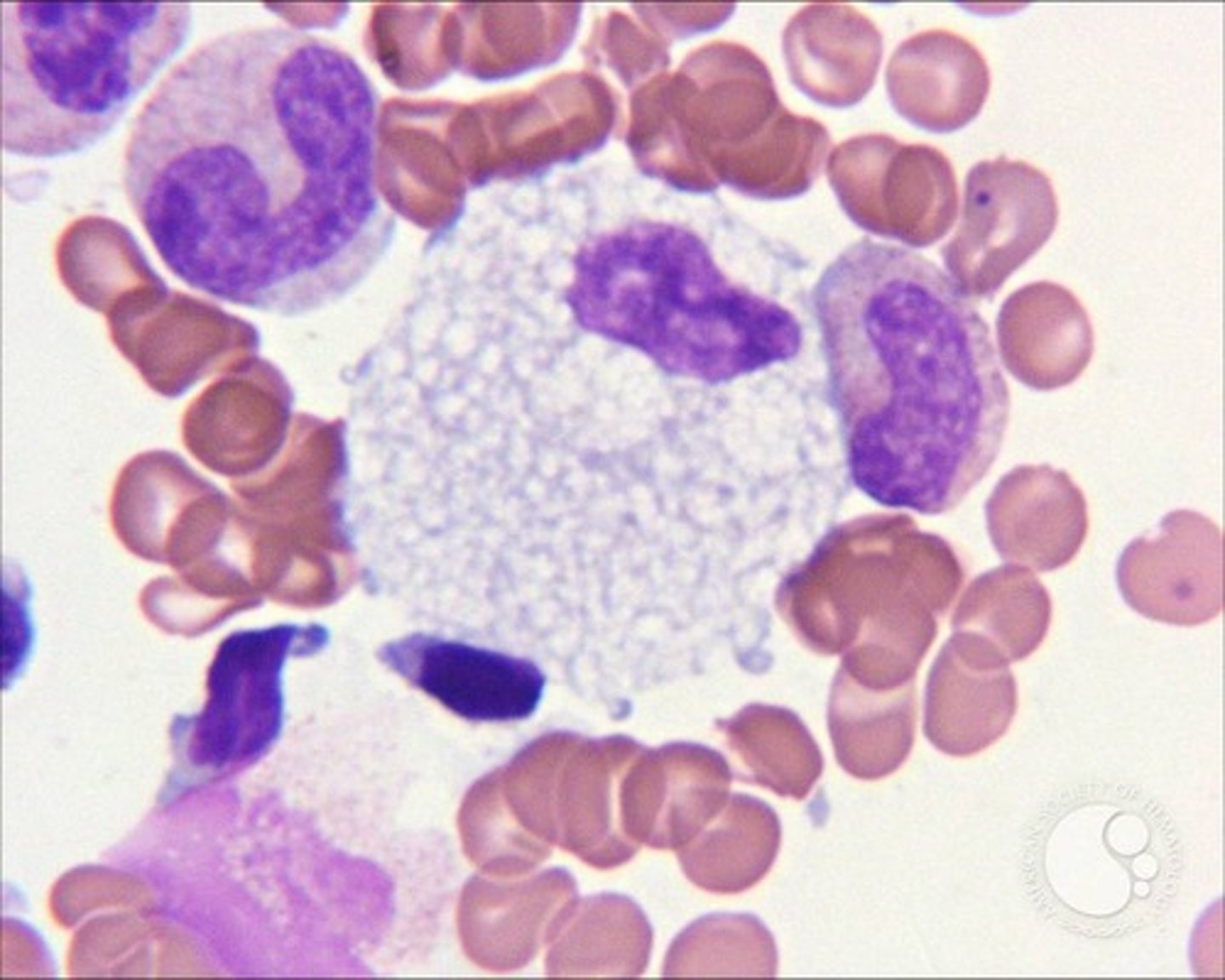 <p>Sphingomyelinase deficiency, can't break down lipids<br>-often fatal by 3 yrs old, <br>-enlarged livers and spleen, also related to leukemia<br>-Characterized by FOAMY macrophages</p>