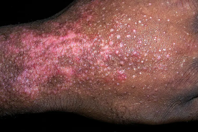 <ol><li><p>redness/swelling</p></li><li><p>itching</p></li><li><p>blisters </p></li><li><p>dry/scaly/cracked skin </p></li></ol><p></p>