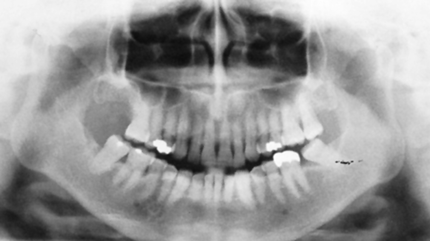 <p>What light needs to be repositioned to fix this image?</p><p>A) mid-sagittal</p><p>B) Frankfort plane</p><p>C) focal trough</p>