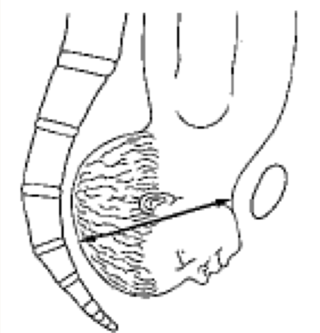 <ul><li><p>head completely extended </p></li><li><p>SBM diameter(9.5cm) </p></li><li><p>Bi temporal diameter (8.2cm)</p></li><li><p>SMV diameter will distend (dilate/expand) the vaginal orifice (11.5cm)</p></li></ul><p></p>