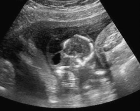 <p><span><span>What abnormality is most likely present in this cross-sectional image of the cranium?<br></span></span></p>