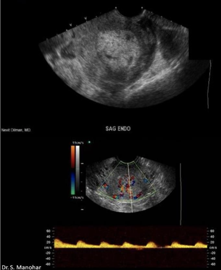 <p>27 yo pregnant pt has <strong>bleeding + pain</strong>. lab testing shows <strong>lower bHCG</strong> than reported 2w ago.</p><p>a) molar pregnancy</p><p>b) endometrial carcinoma</p><p>c) endometrial hyperplasia</p><p>d) retained products of conception</p>