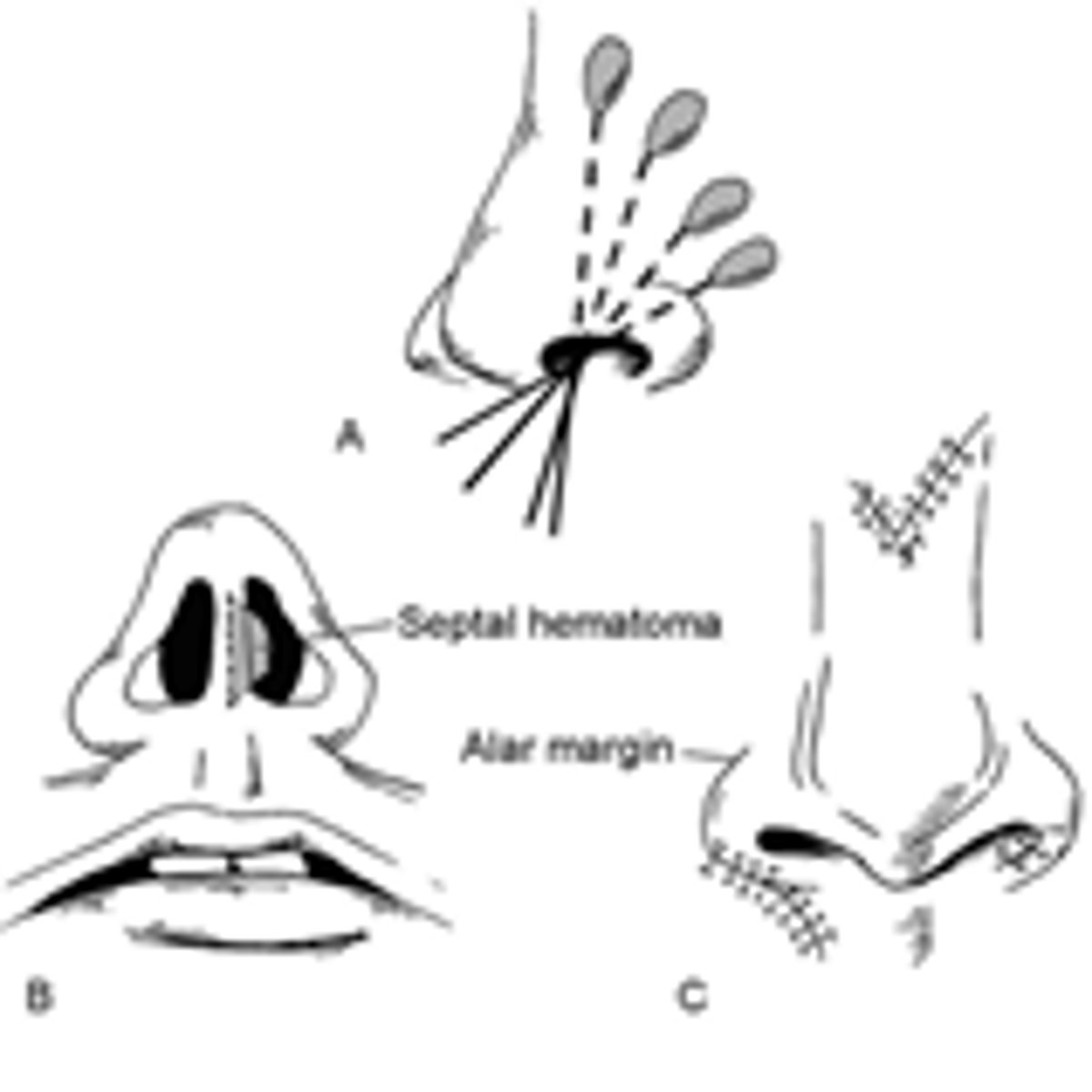 <p>- Anesthetize w liquid cocaine</p><p>- Start at rim of ala and work way out</p><p>- Ensure septal hematoma is not present</p>