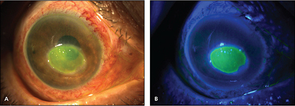 <p>What is this fluorescein stain showing?</p>