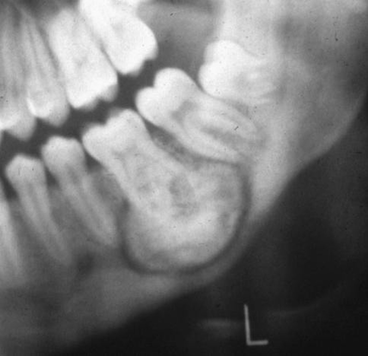 <p>• asymptomatic</p><p>• associated with impacted/unerupted teeth</p>