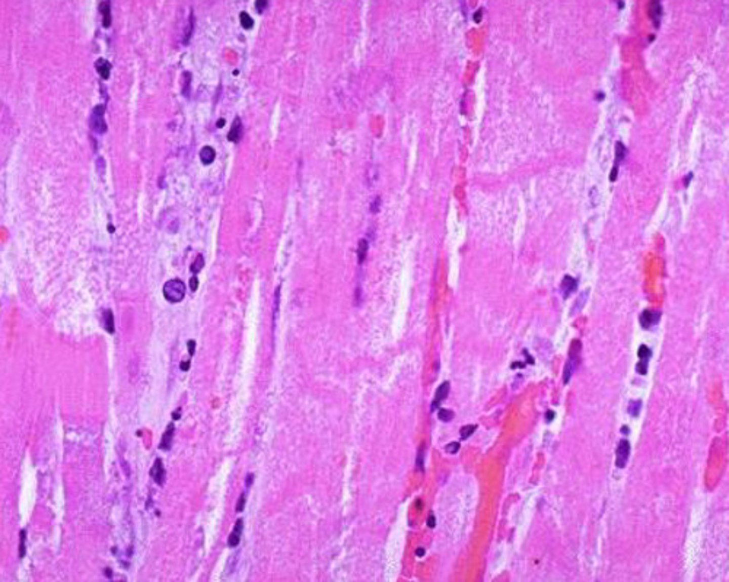 <p>What kind of necrosis is shown?</p>