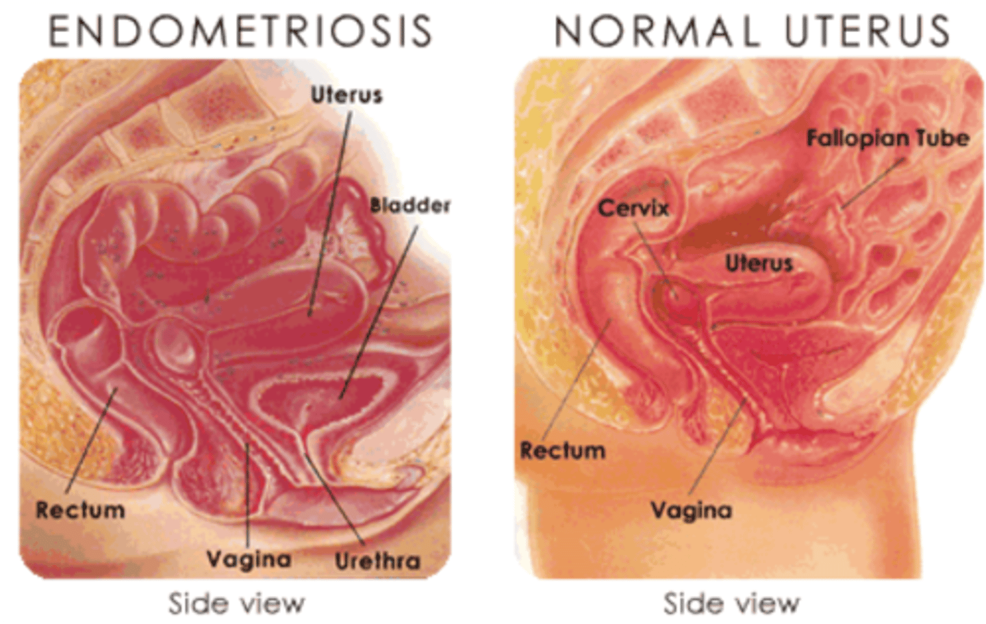 <p>abnormal condition where endometrial tissue occurs in various areas in pelvic cavity</p>