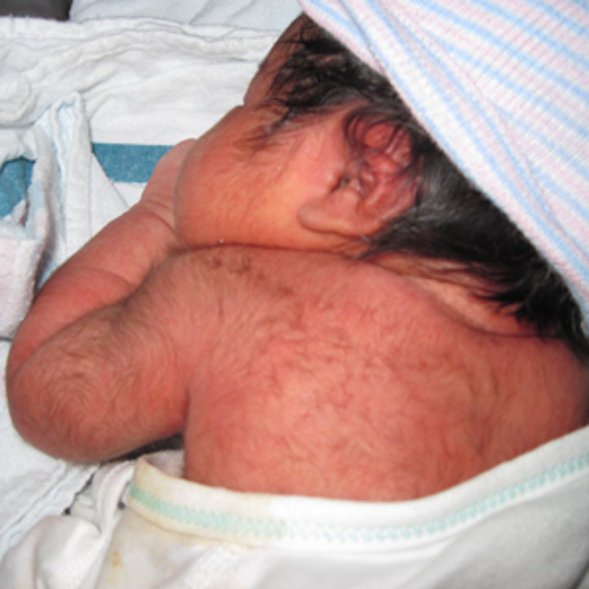 <p>peach fuzz hair that sheds on its own, common in premature kiddos</p>