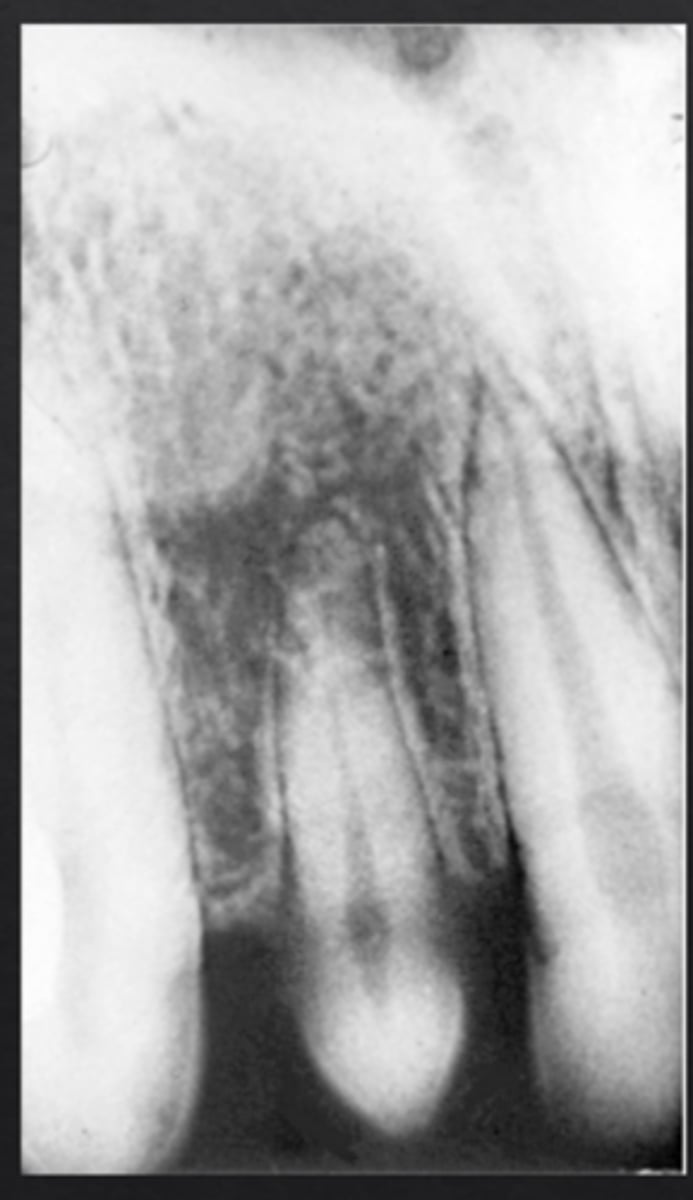 <p>Maxillary lateral incisor (peg lateral)</p>