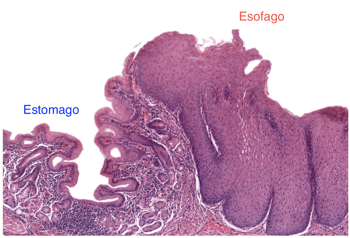 <ul><li><p>Glándulas</p></li><li><p>Celulas calciformes (producción de moco)</p></li><li><p>Cambio adaptativo con metaplasia (epitelio escamoso —> epitelio cilíndrico con celulas calciformes que son similares a las del intestino)</p></li><li><p>Displasia y neoplasia que son riesgo de la patologia</p></li><li><p>Cambio de color (blanco —> rojo)</p></li></ul><p></p>