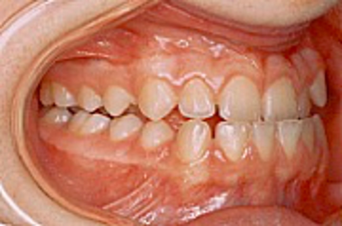 <p>ID the class of occlusion:</p>