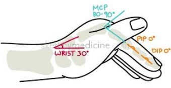 <p><strong><mark data-color="yellow" style="background-color: yellow; color: inherit">AKA SAFE POSITION SPLINT</mark></strong></p><p>-<strong>20 </strong>deg wrist ext</p><p>-<strong>90 </strong>deg MCP flex</p><p>-PIP/DIP 0 deg ext (full)</p><p></p><p>for burns to hand or dorsal hand</p><p></p>