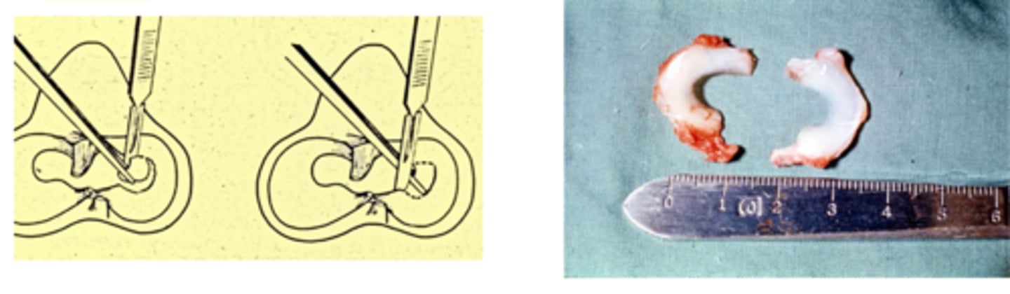 <p>total meniscus removal induces....</p>