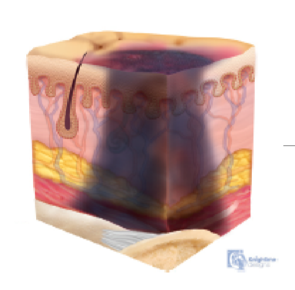 <p>Damage to underlying soft tissue</p>