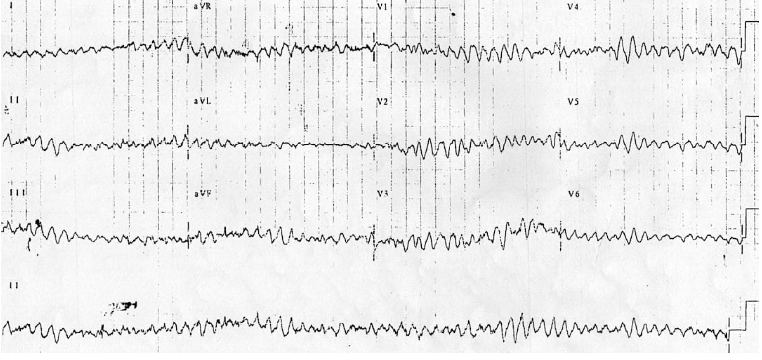 <p>Short term treatment for V fib</p>