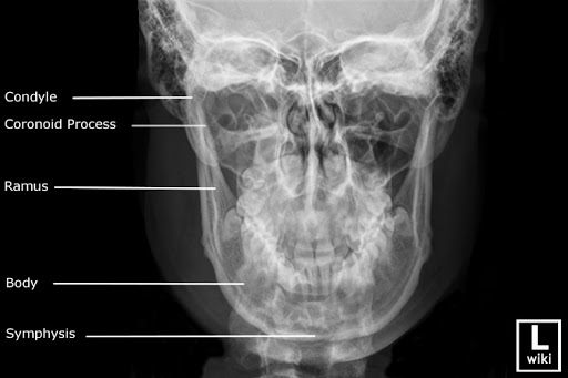 <p><strong>What is the degree of angle and CR location for this mandibular image?</strong><br>A. 15 degree caudal; Nasion<br>B. 0 degree angulation; center of lips<br>C. 0 degree angulation; Nasion<br>D. 15 degree caudal; center of lips</p>