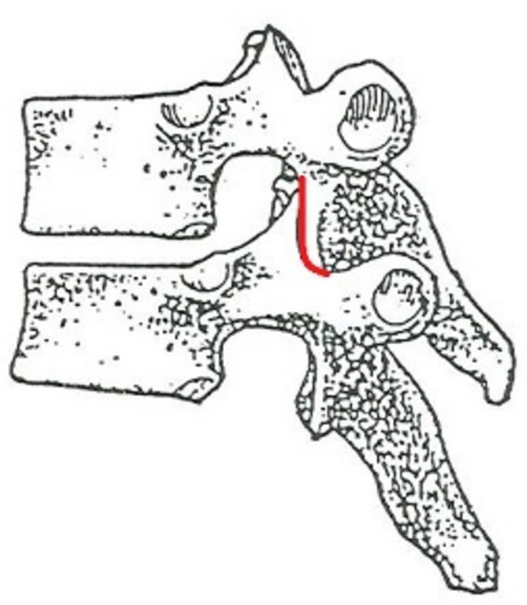 <p>What does the red line represent?</p><p>intervertebral foramen</p><p>zygopophyseal joint</p><p>intervertebral body</p><p>costovertebral joint</p>