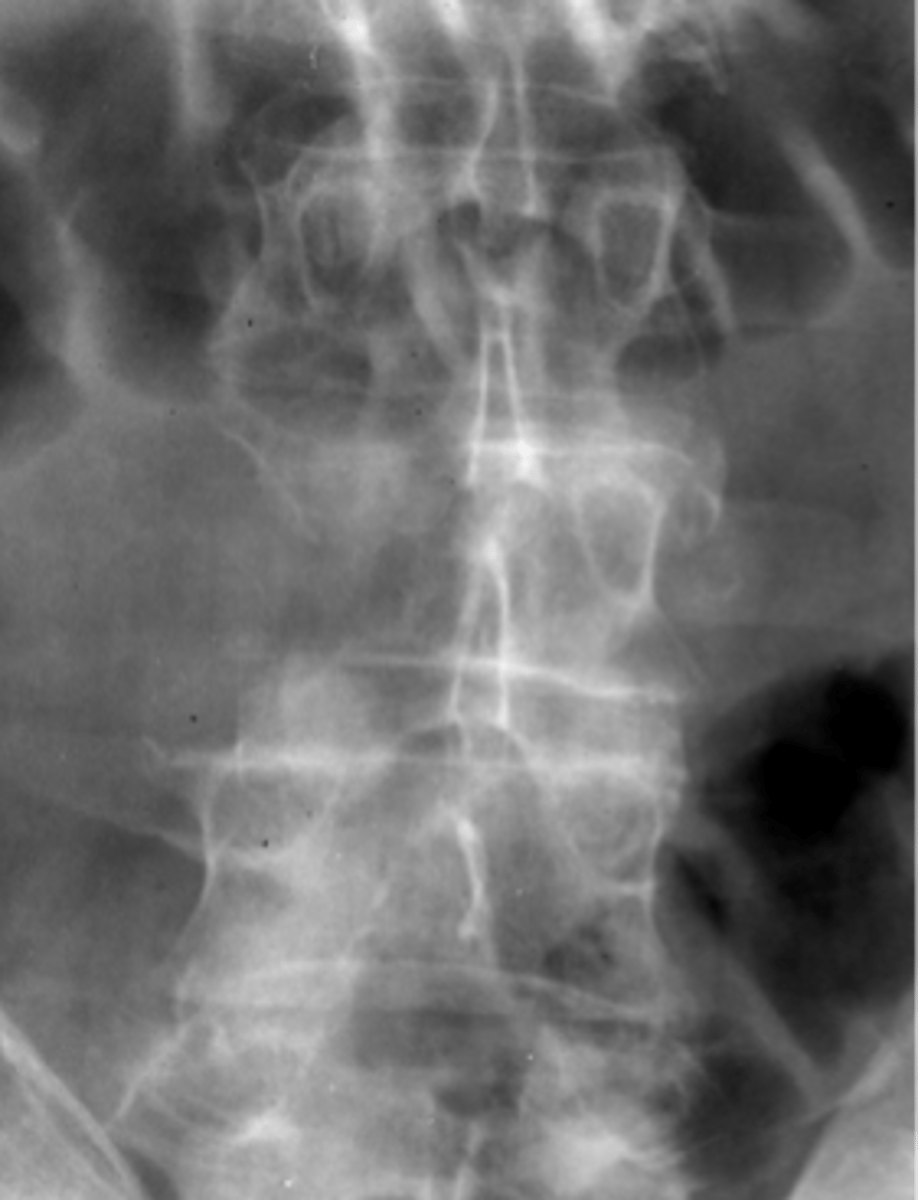 <p>- Missing pedicle</p><p>- Soft tissue mass</p><p>- Vertebral body destruction</p>