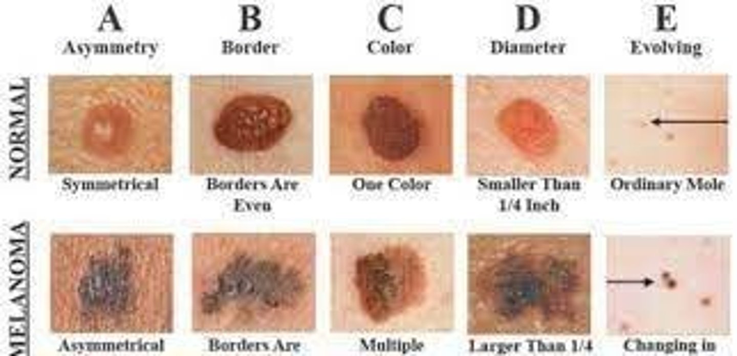 <p>Skin cancer arising from melanocytes, can also be present on nails, oral mucosa, genital regions, and conjunctiva.</p>