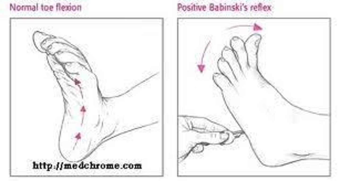 <p>A positive Babinski sign indicates an Upper Motor Neuron lesion.</p>