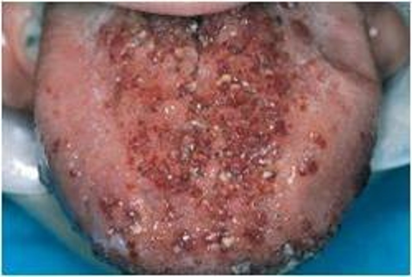 <p>Red (or white/pink), soft, fluctuant, pebbly surface (caviar)</p><p>• common location: anterior dorsal tongue</p><p>• population: children</p><p>• on neck: Cystic Hygroma</p>