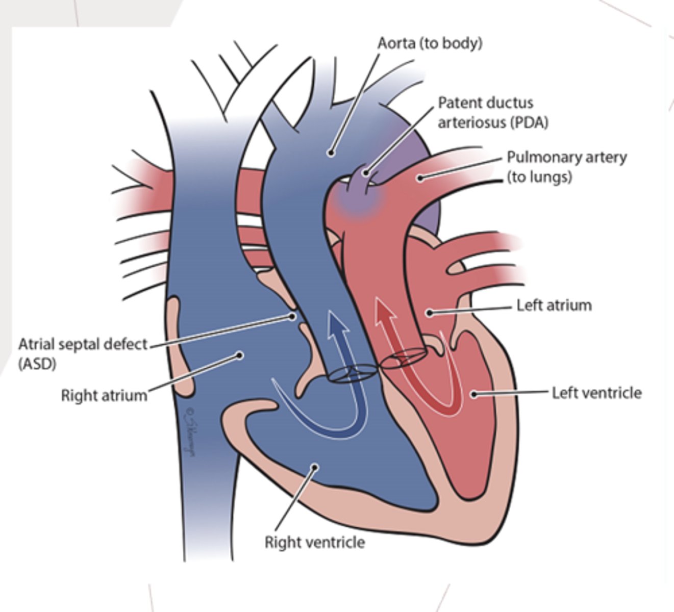 <p>a congenital, cyanotic heart defect where the aorta communicates with the right ventricle, and the pulmonary artery communicates with the left ventricle</p>
