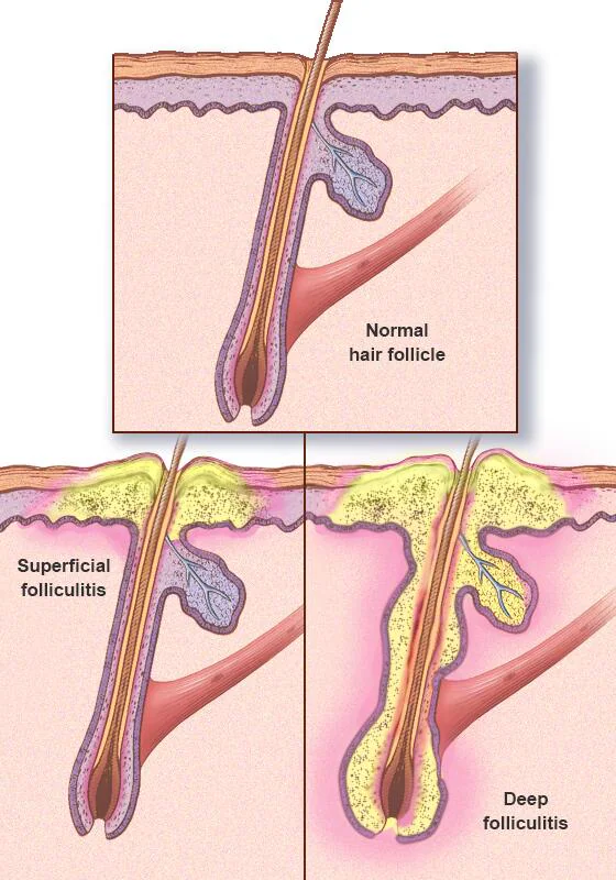 <ol><li><p>ingrown hair </p></li><li><p>bacterial </p></li><li><p>fungal</p></li><li><p>viral infection </p></li><li><p>friction </p></li><li><p>irritation </p></li></ol><p></p>
