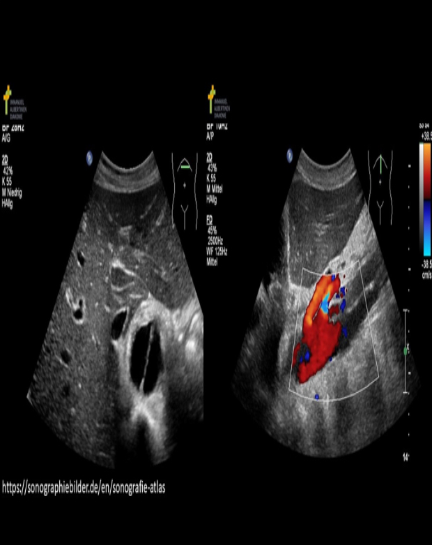 <p>The findings on the image are common complication of:</p><p>A)Marfan syndrome </p><p>B) Lupus </p><p>C) Leriche syndrome </p><p>D) Irritable bowel syndrome </p>