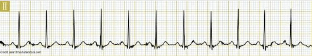 <p>regular rhythm; HR &gt; 100</p>