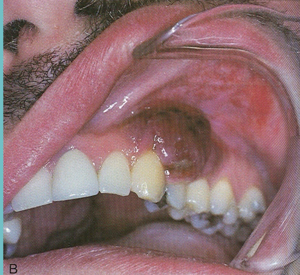 <p>Kaposi’s sarcoma </p>