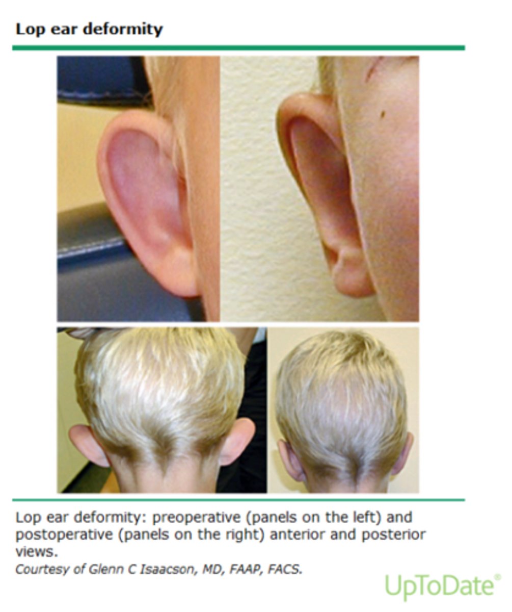 <p>when children ears stick out. can be resolved with pinning</p>