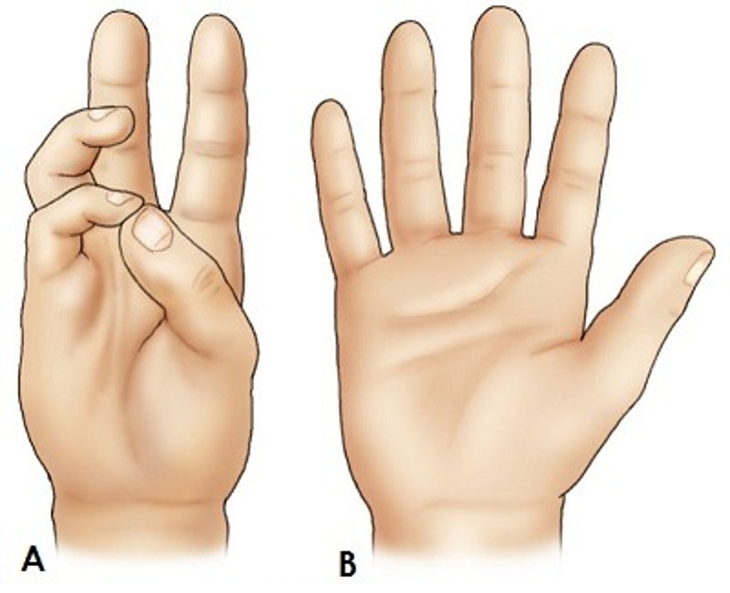 <p>Moving the thumb back to its anatomical position</p>