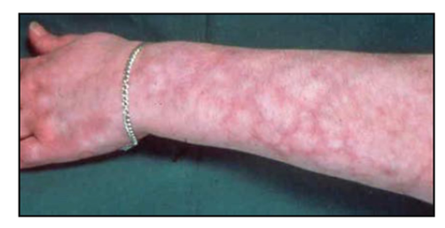 <p>is patchy discoloration indicating primary or secondary changes of the deep, middle, or superficial dermal blood vessels</p>