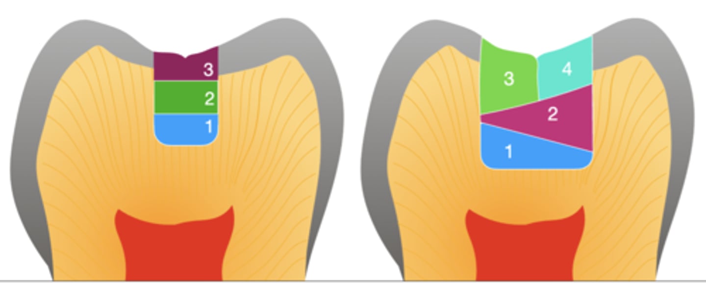 <p>incremental layering</p><p>- Horizontal layers for small isthmus and oblique layers for larger restorations</p>