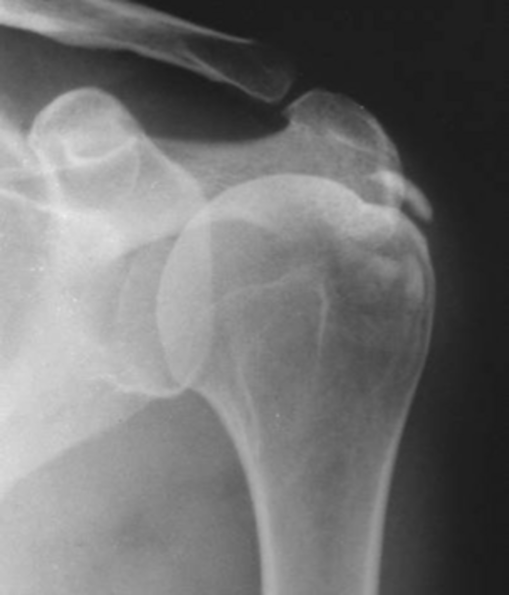 <p>Hydroxyapatite deposition disease (HADD) of the _____</p>