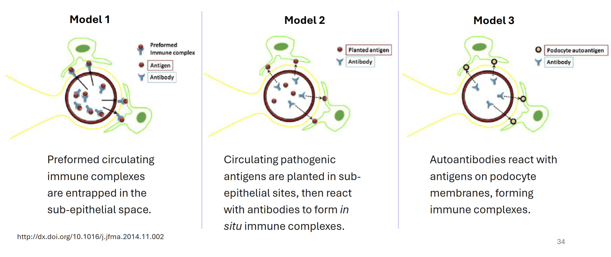 <p>All models involve subepithelial deposition of immune complexes (immune mediated) → abnormal pordocyte membranes → thickened glomerular membrane, leading to difficult filtration </p><p>Model 1 - preformed antigen-antibody complexes deposit into sub-epithelial space</p><p>Model 2 - circulating pathogenic antigens planted in subepithelial sites, react with antibodies to form immune complexes </p><p>Model 3 - autoantibodies react with antigens on podocyte membranes, which forms immune complexes</p><p>Autoantibodies against phospholipase A2 receptor and myeloperoxidase are common triggers </p>