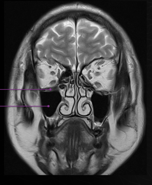 <p>Maxillary</p>