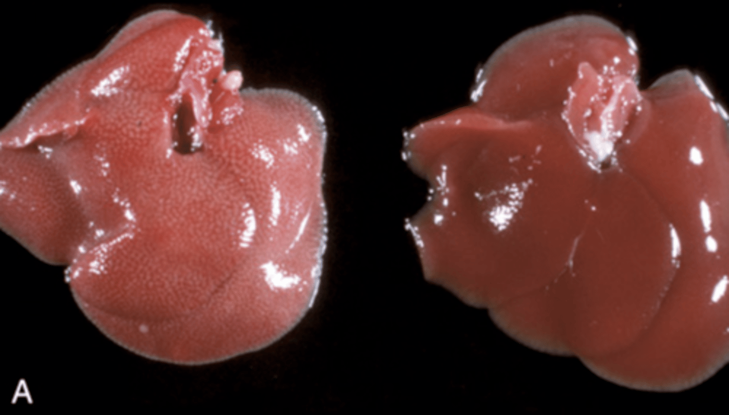 <p>What type of acute cell swelling is being shown in this image?</p><p>1. Cytoxic edema</p><p>2. Balloning degernation</p><p>3. Hydropic degeneration</p>