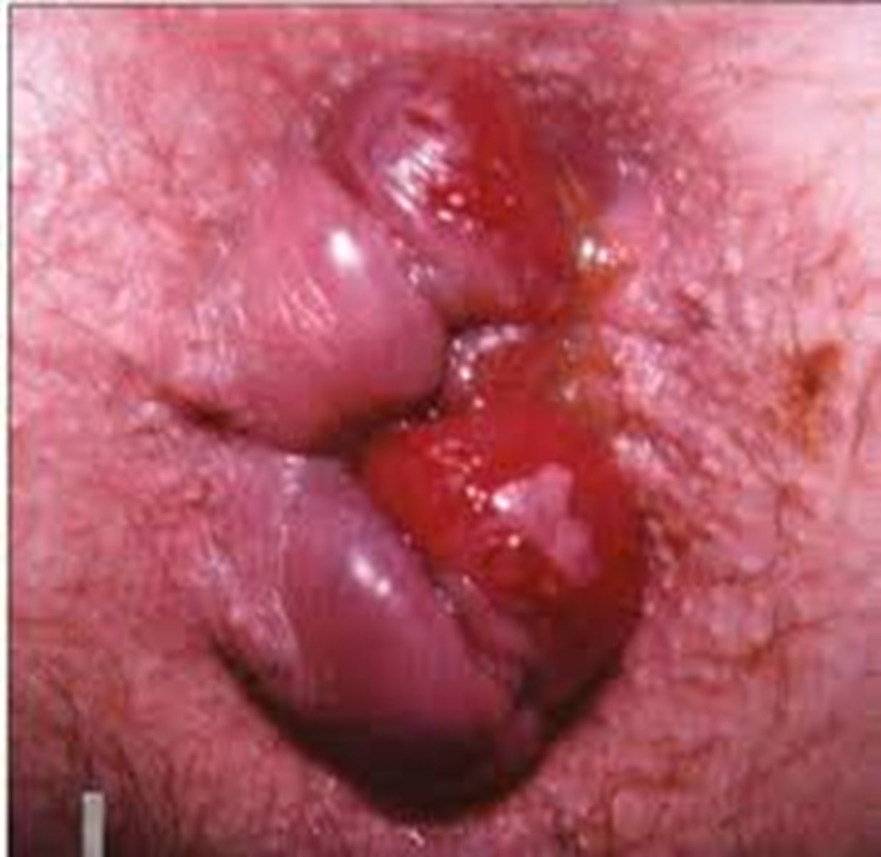 <p>Hemmrhoids</p><p>Backing up of blood into the inferior rectal vein</p>