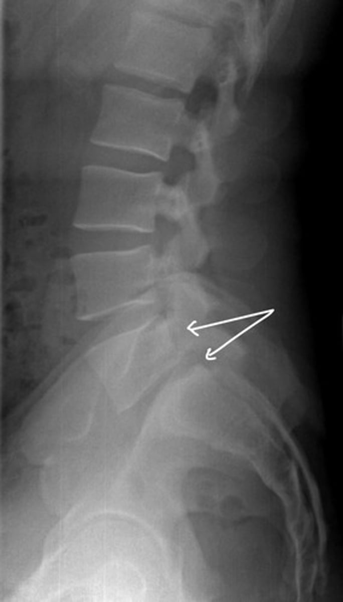 <p>This type of spondylolisthesis is associated with lucency on x-ray. What type of spondy is this?</p>