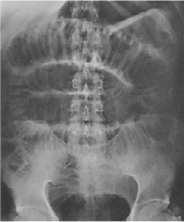 <p>Imaging findings of Ileus</p>