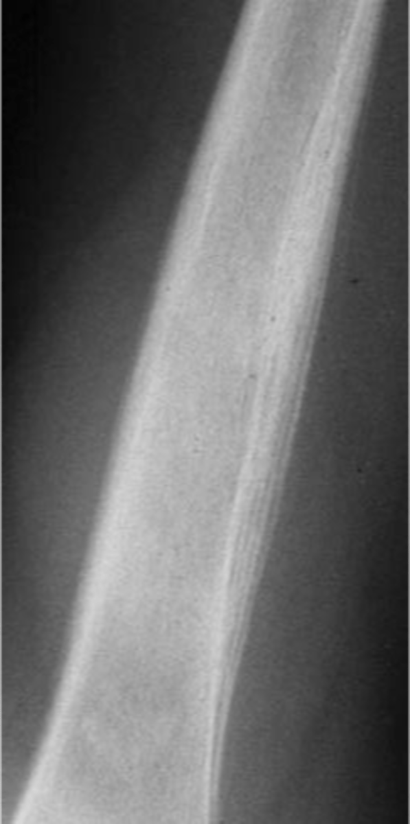 <p>Ewing's Sarcoma has a _____ 5-year survival</p>