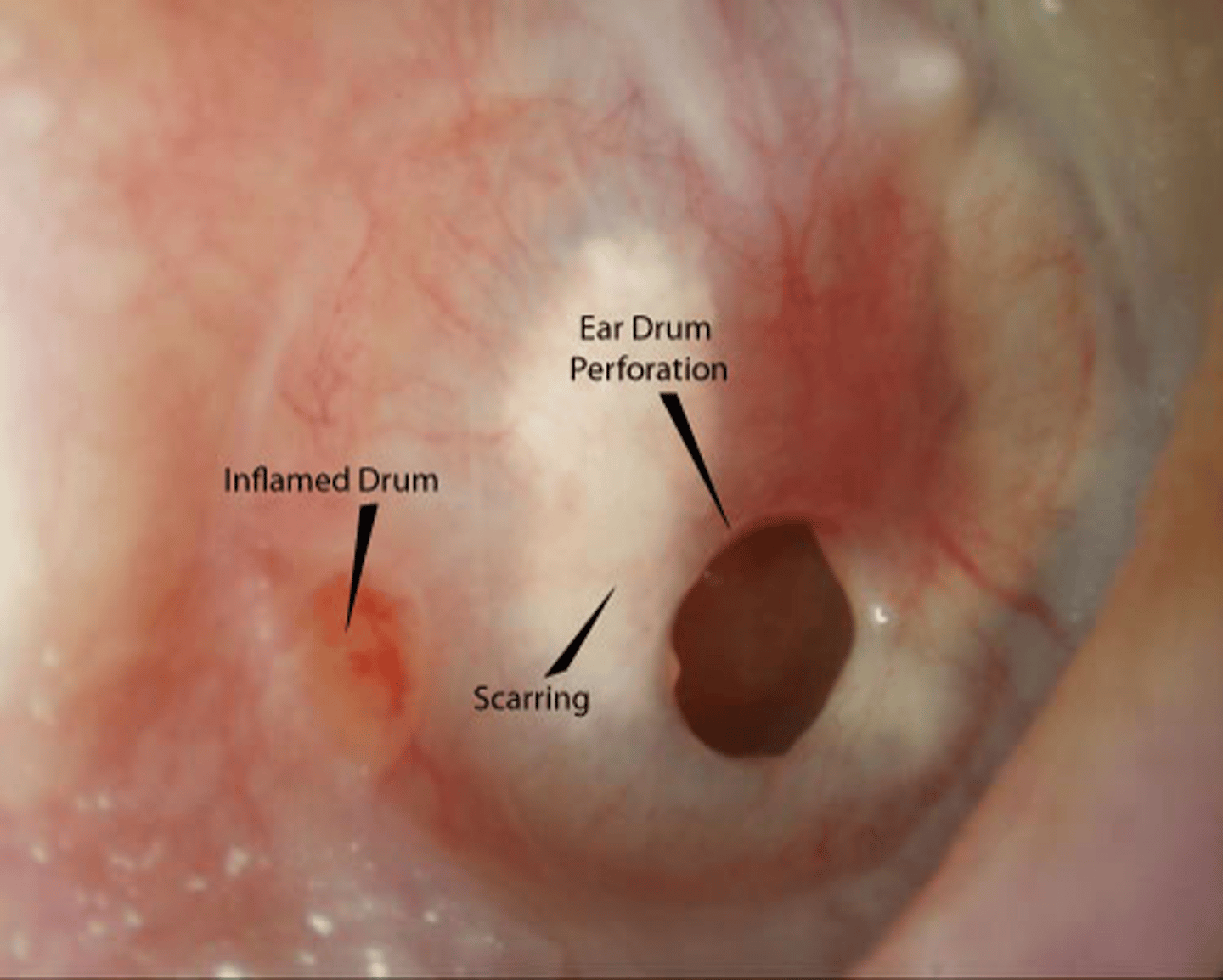 <p>Occurs when the thin tissue separating the ear canal from the eardrum is torn</p>