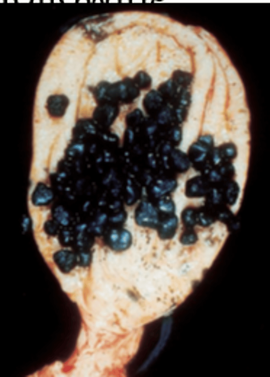 <p>A 40-year-old black woman has frequent indigestion after meals and abdominal pain. Physical examination demonstrates a moderately obese woman in no acute distress. An ultrasound examination demonstrates numerous echogenic objects within the gallbladder. A cholecystectomy is performed, and the surgical specimen is shown in the image. The gallstones seen in this patient are typically associated with which of the following diseases?</p><p>(A) Chronic pancreatitis</p><p>(B) Diabetes mellitus</p><p>(C) Familial hypercholesterolemia</p><p>(D) Hyperparathyroidism</p><p>(E) Sickle cell disease</p>