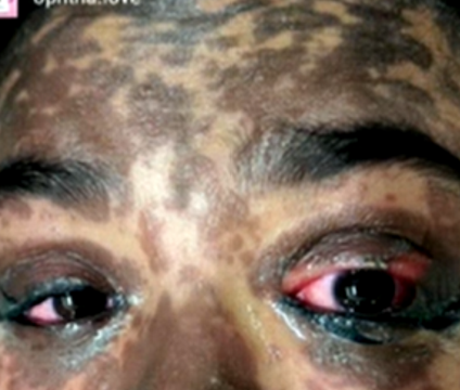 <p>What eyelash condition is this?</p><ul><li><p>&gt;30% of body surface area</p></li></ul><p></p>