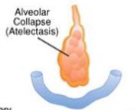 <ul><li><p>alveolar collapse</p></li><li><p>often caused by anaesthesia</p></li></ul><p></p>