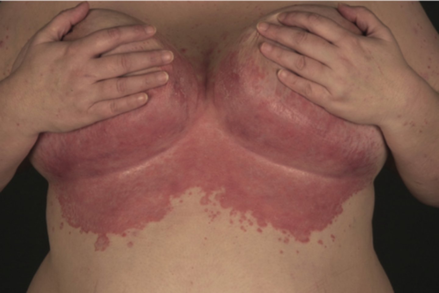 <p>axillae, groin, inframammary folds</p>