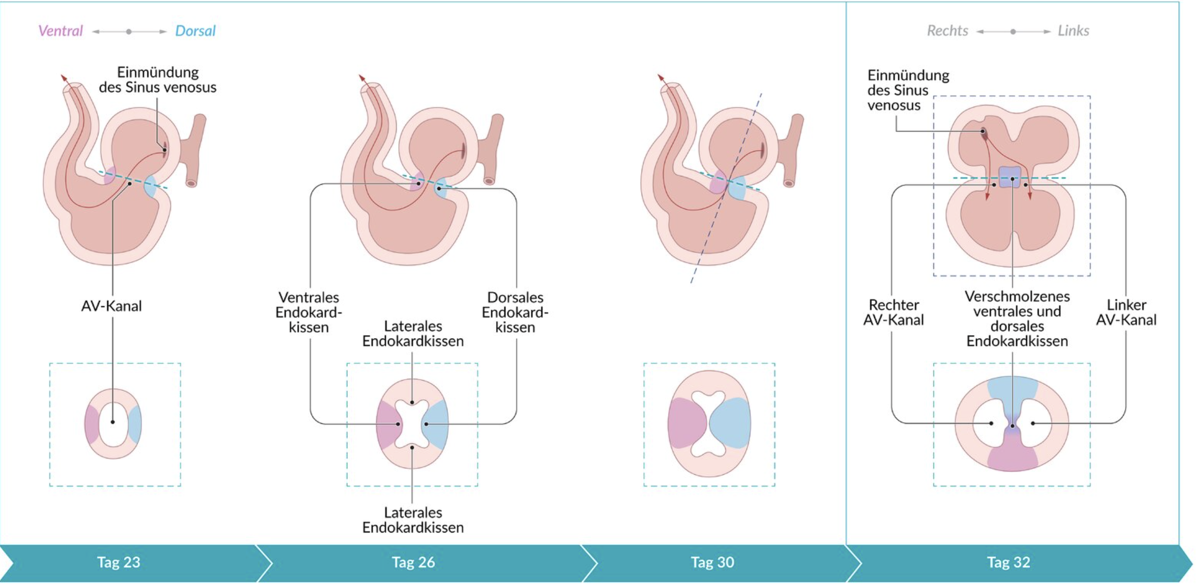 <p>B. Fusion of the endocardial cushions</p>
